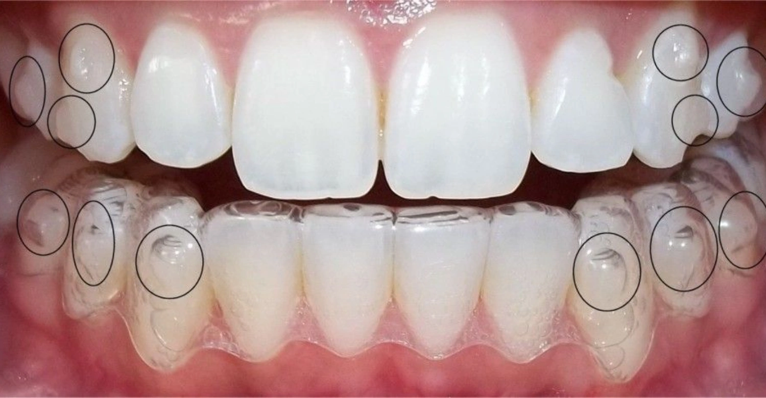 Clear Aligner Attachments: What They Are & Why They Matter - Vitrin Clinic