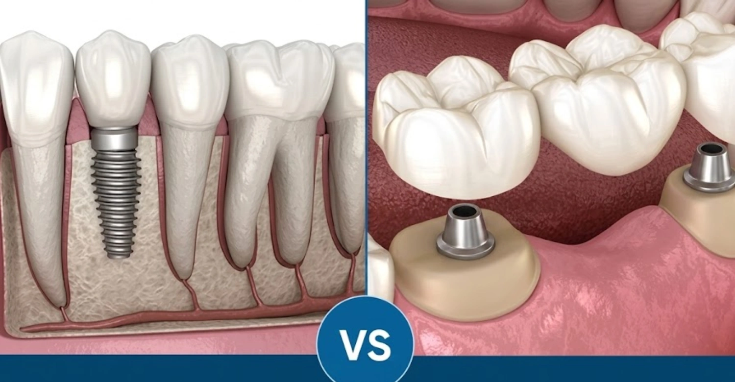Dental Bridge vs Implant