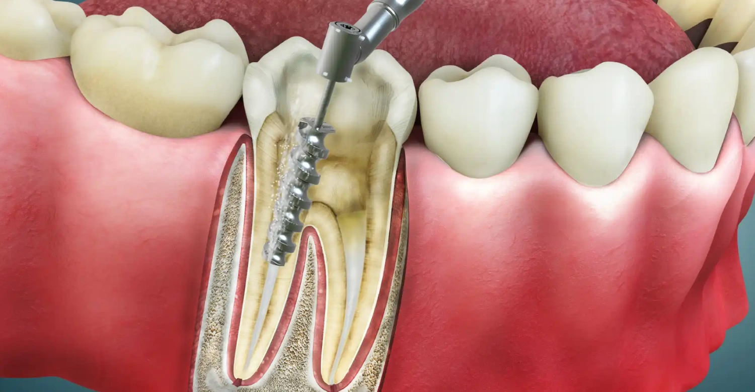 Jaw pain after root canal
