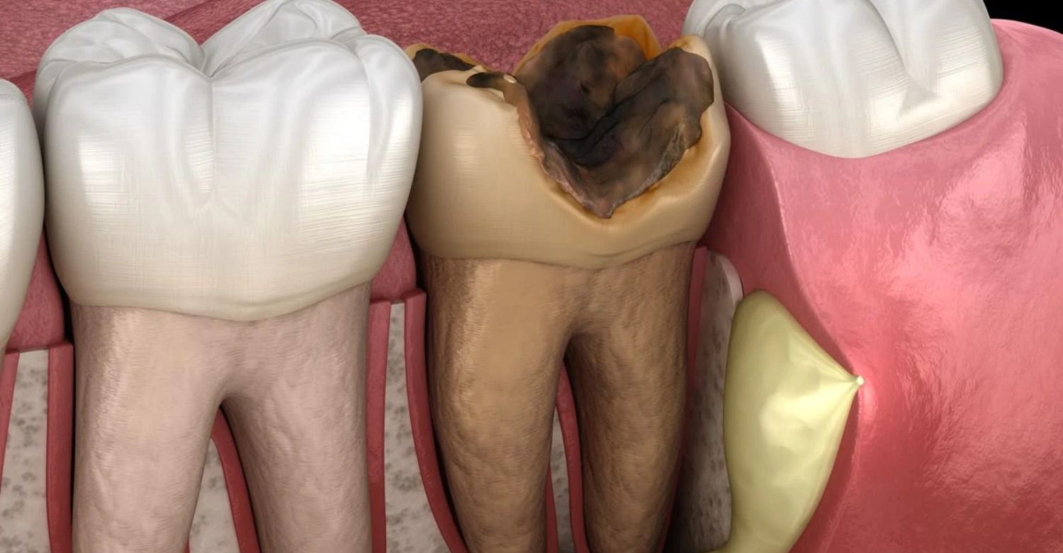 Rotten Teeth and Treatment1